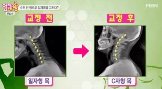 생활속에서 쉽게 거북목 &amp; 일자목 고치는 방법